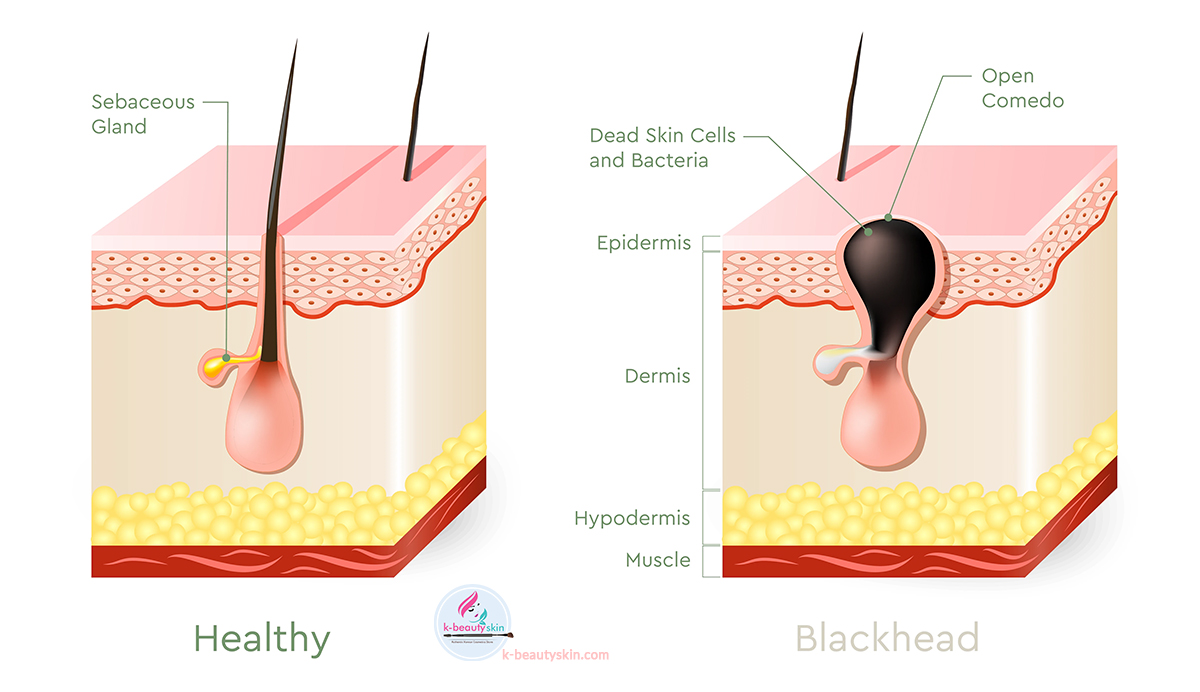 What is Blackheads? Best K-beauty Products For Blackheads`